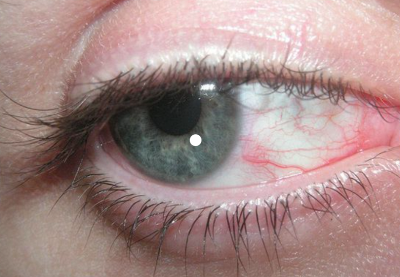 Penyebab Mata Merah Sebelah dan Cara Mendiagnosisnya? 사진 4