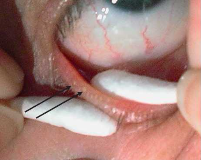 متى وكيف يجب تنظيف غدد الميبوميان؟ 사진 6