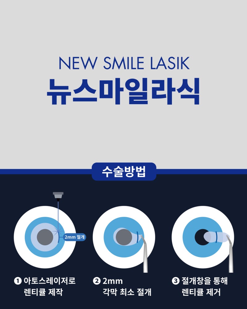 江南Smile眼科新Smile雷射的效果與安全性