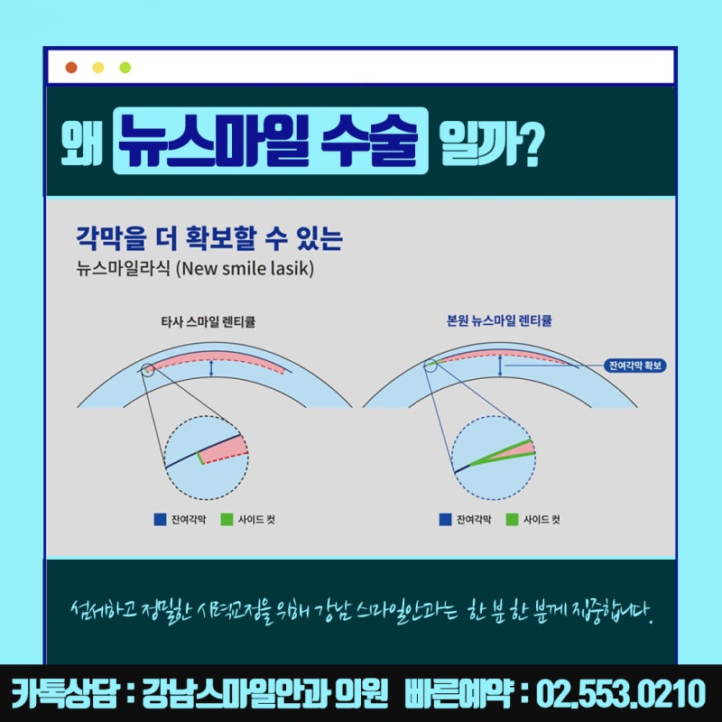 جراحة نيوسمايل في سيول، عيادة جانجنام سمايل للعيون المشهورة بـ LASIK و LASEK :) 사진 16