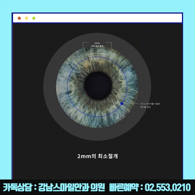 جراحة نيوسمايل في سيول، عيادة جانجنام سمايل للعيون المشهورة بـ LASIK و LASEK :) 사진 8