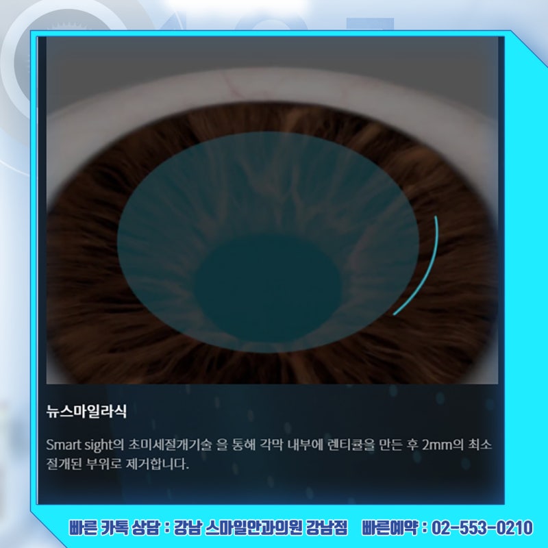 رؤية جديدة، استشارة حول سعر عملية Newsmile Lasik في عيادة جانجنام سمايل لطب العيون 사진 12