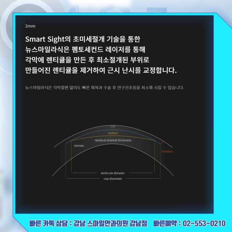 رؤية جديدة، استشارة حول سعر عملية Newsmile Lasik في عيادة جانجنام سمايل لطب العيون 사진 10