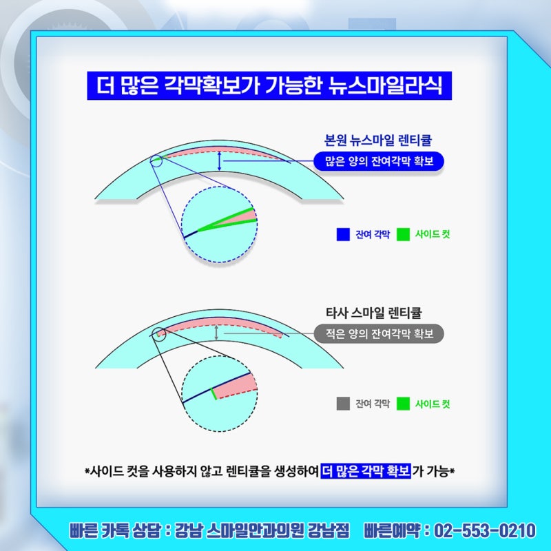 رؤية جديدة، استشارة حول سعر عملية Newsmile Lasik في عيادة جانجنام سمايل لطب العيون 사진 17