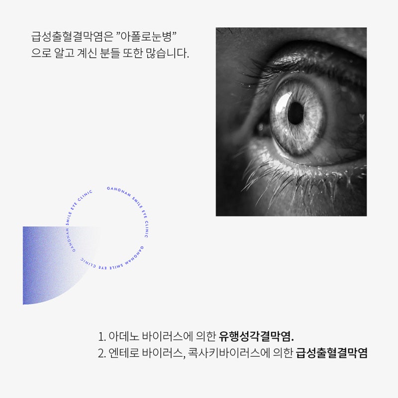 夏季假期後想了解的眼疾？！在江南眼科檢查一下 :)