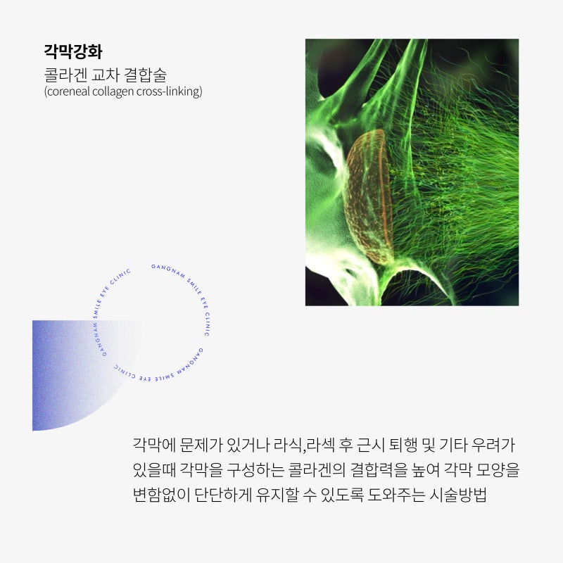 LASIK/LASEK手術，角膜強化術是必需的嗎？