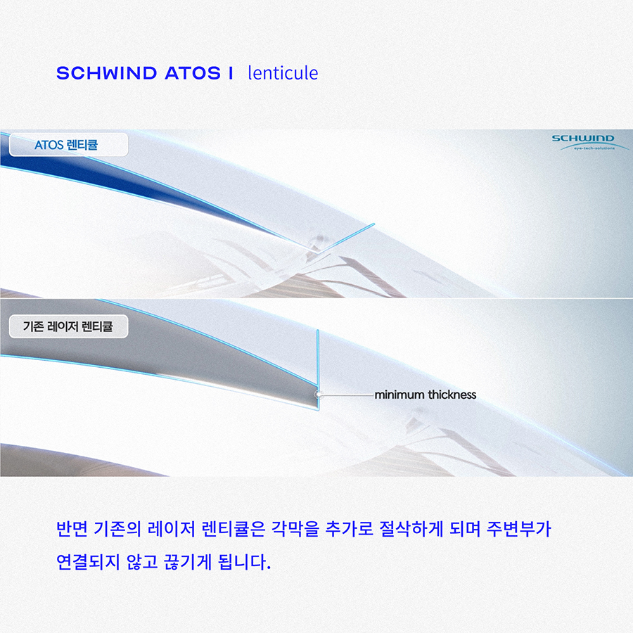 SMILE手术最理想的形式 사진 3