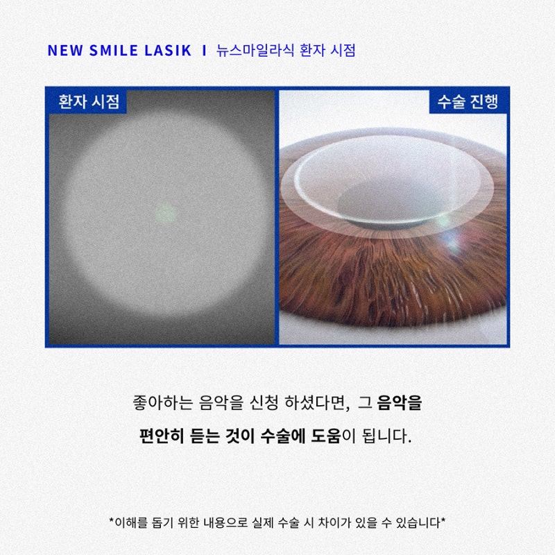 New SMILE手术患者视角(第一人称) 사진 6
