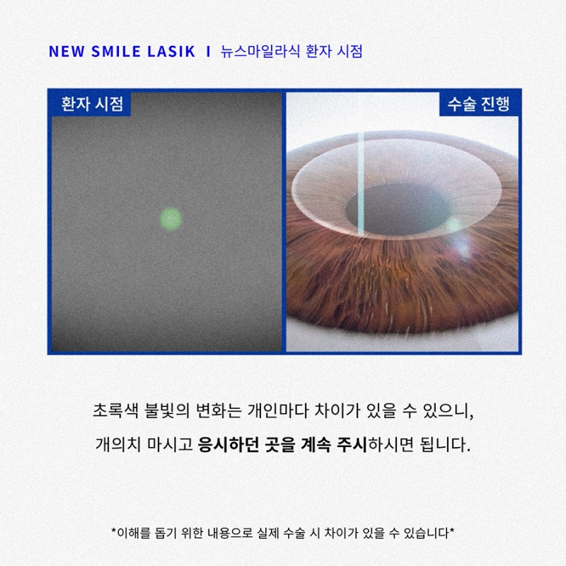 New SMILE手术患者视角(第一人称) 사진 5