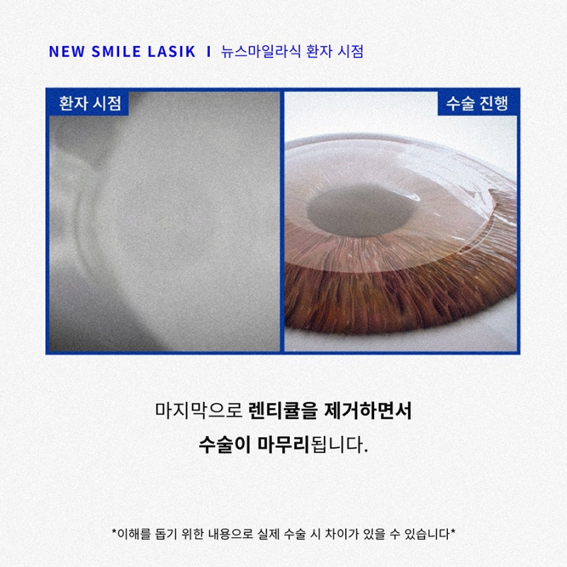 New SMILE手术患者视角(第一人称) 사진 7