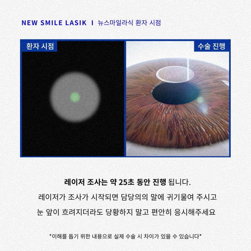 New SMILE手术患者视角(第一人称) 사진 4