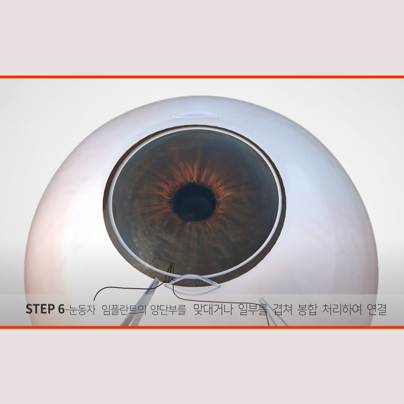 江南,瞳孔放大整形“美瞳环”手术,告别不适的彩色隐形眼镜! 사진 9