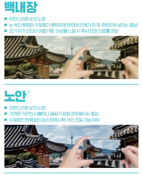 最近热门的韩国人定制白内障晶体‘Pure See’ 사진 2