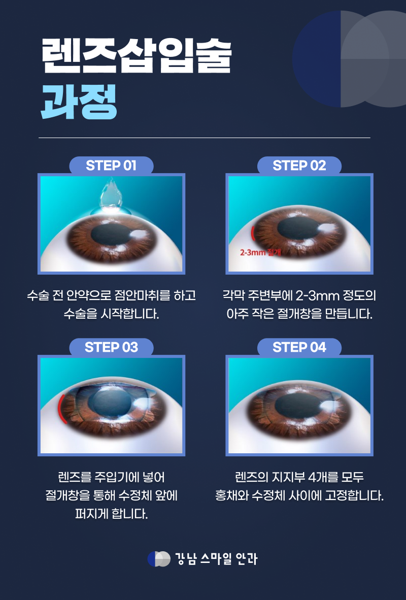 [Gangnam Smile Eye Clinic] การผ่าตัดใส่เลนส์เสริม: สายตาจะยังคงเหมือนเดิมหลังจาก 10 หรือ 20 ปีหรือไม่? 사진 3