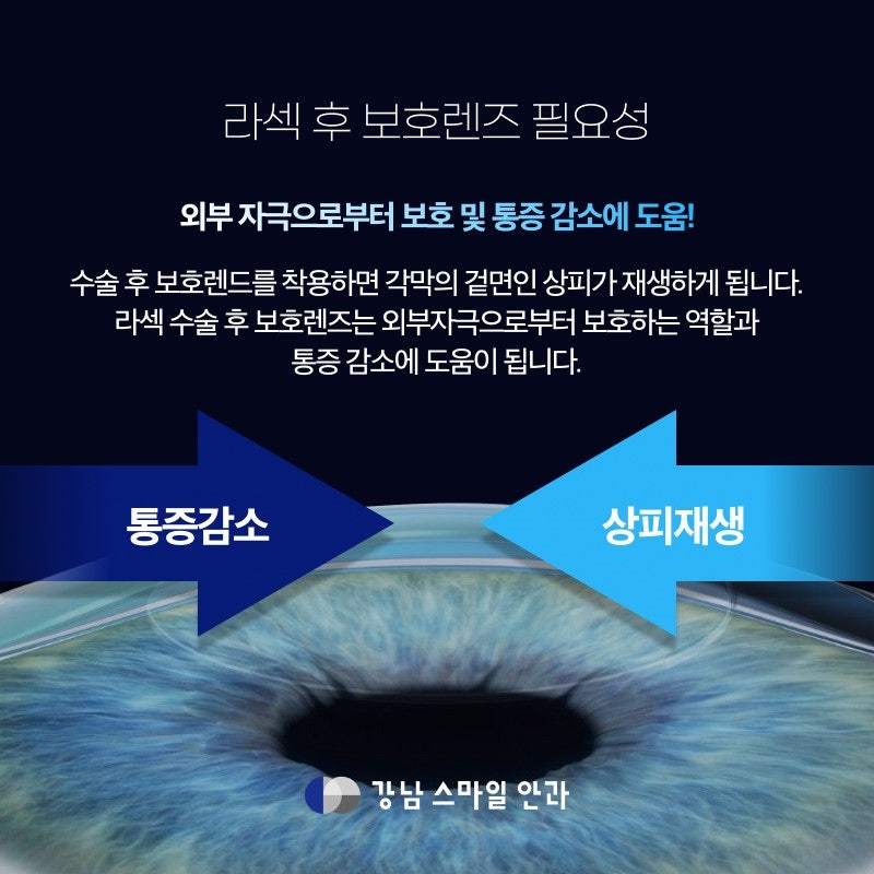 ラゼック後の保護レンズ着用理由と推奨着用期間