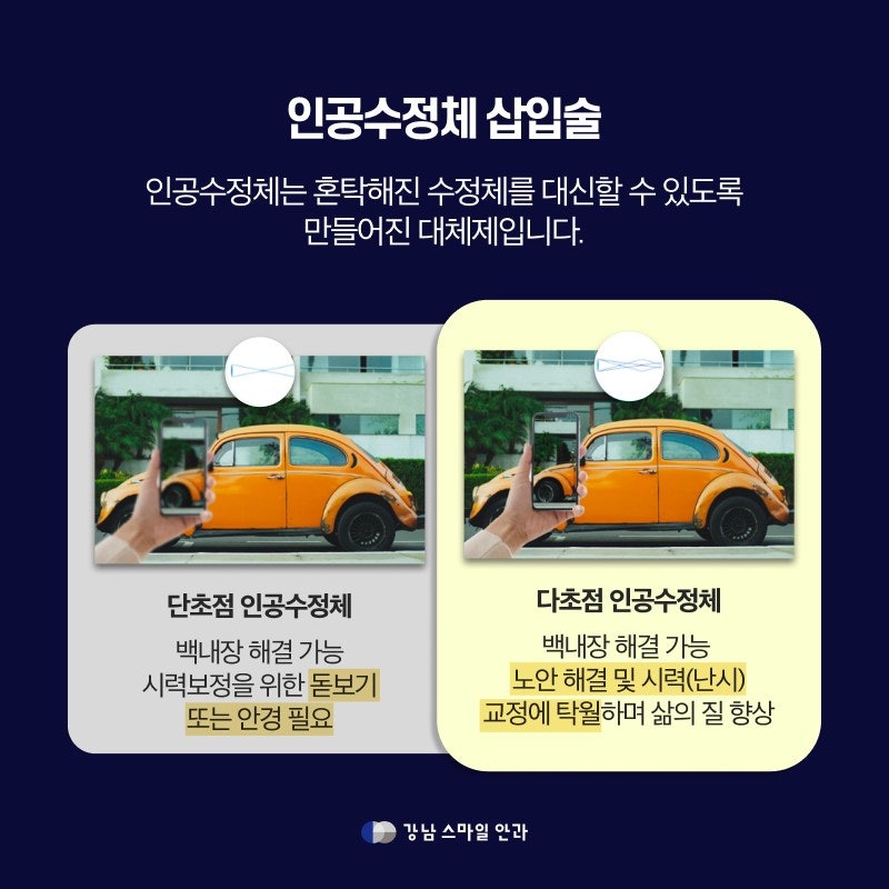 白内障の種類に応じた適切な手術のゴールデンタイムは？