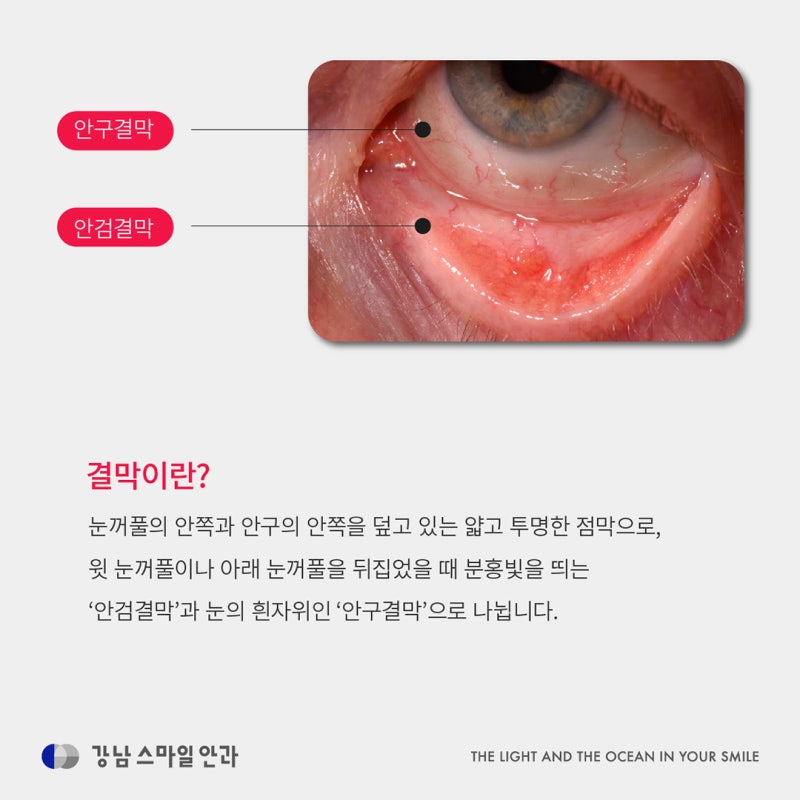 Air mata, sensasi benda asing, mata merah, bukan mata kering tapi konjungtiva longgar? (Pengobatan konjungtiva longgar)
