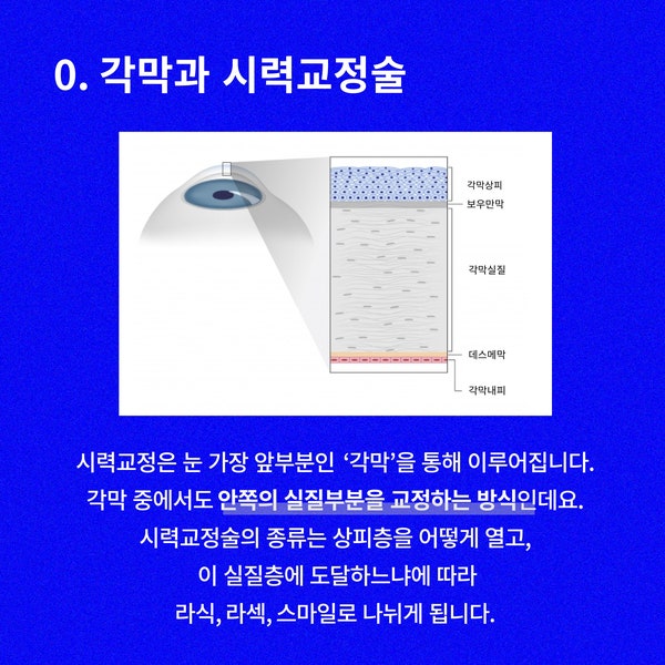 스마일라식 라섹 차이, 스마일라식부작용 | 강남 스마일라식 비용 사진 2