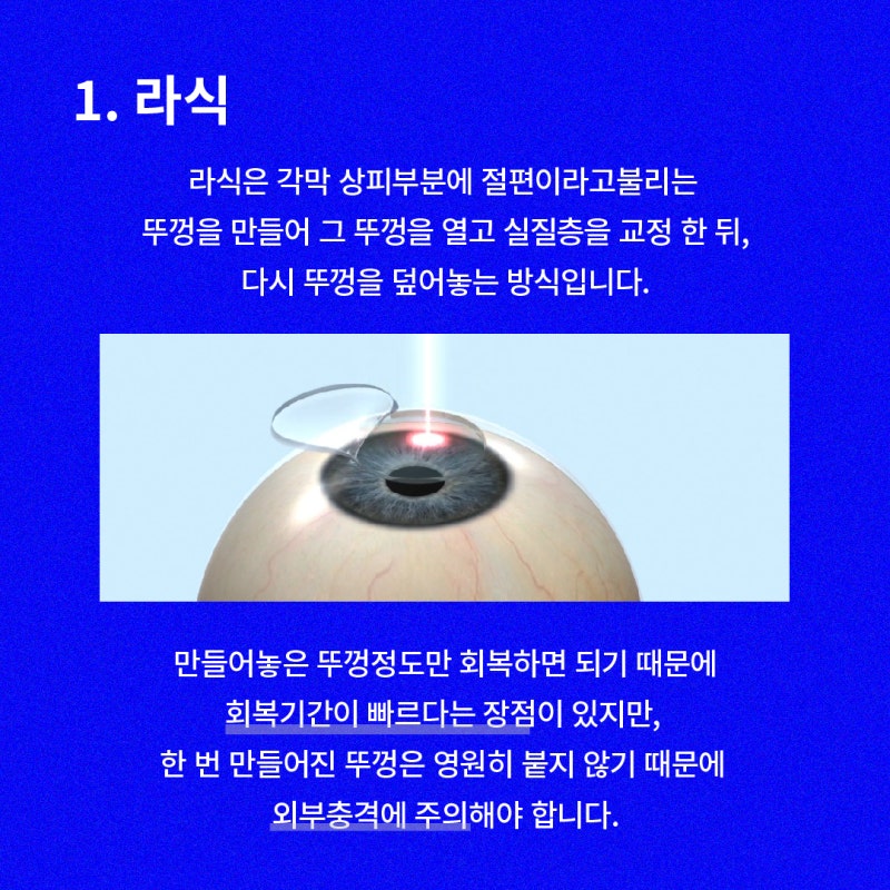 스마일라식 라섹 차이, 스마일라식부작용 | 강남 스마일라식 비용 사진 3