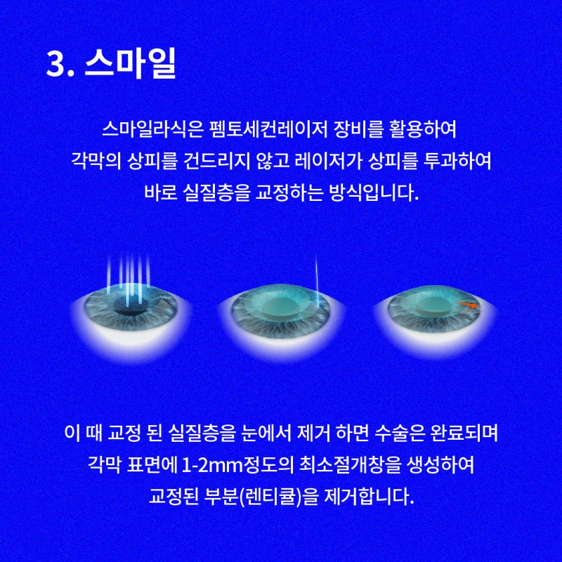 스마일라식 라섹 차이, 스마일라식부작용 | 강남 스마일라식 비용 사진 5