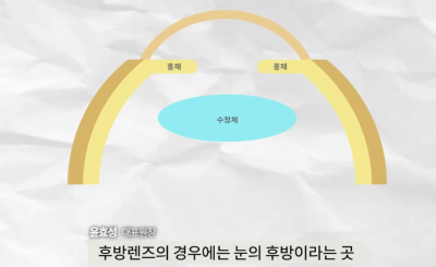 ค่าใช้จ่ายในการผ่าตัดฝังเลนส์ | ทำไมถึงแพงจัง? ทุกสิ่งเกี่ยวกับการผ่าตัดฝังเลนส์ A ถึง Z 사진 6