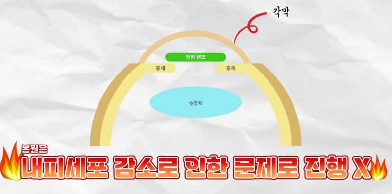 ค่าใช้จ่ายในการผ่าตัดฝังเลนส์ | ทำไมถึงแพงจัง? ทุกสิ่งเกี่ยวกับการผ่าตัดฝังเลนส์ A ถึง Z 사진 8