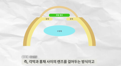 ค่าใช้จ่ายในการผ่าตัดฝังเลนส์ | ทำไมถึงแพงจัง? ทุกสิ่งเกี่ยวกับการผ่าตัดฝังเลนส์ A ถึง Z 사진 5