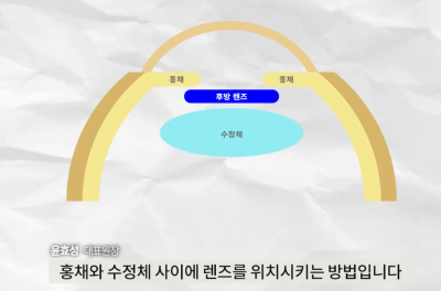 ค่าใช้จ่ายในการผ่าตัดฝังเลนส์ | ทำไมถึงแพงจัง? ทุกสิ่งเกี่ยวกับการผ่าตัดฝังเลนส์ A ถึง Z 사진 7