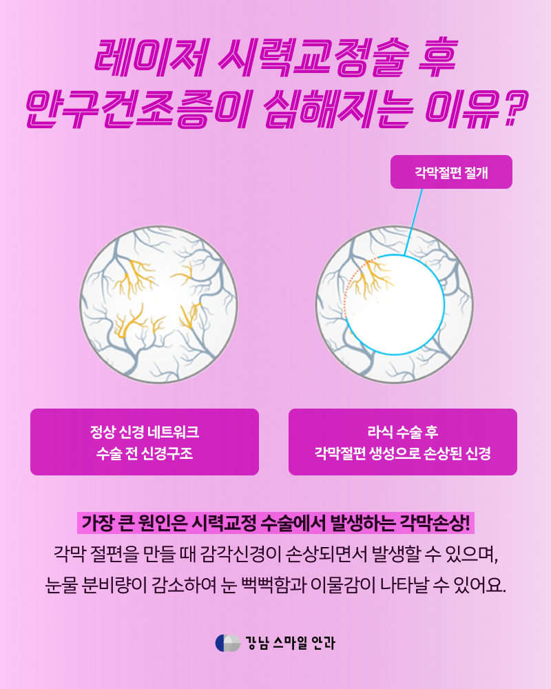 眼部IPL | 微笑激光术后需要干眼症护理的原因(日常小贴士) 사진 2