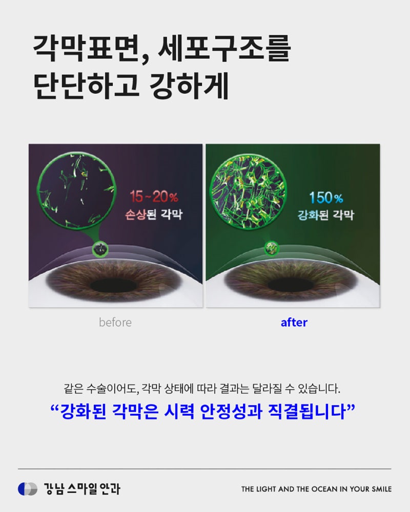 什么是角膜强化术,如何预防视力退化? | 江南站眼科 사진 5