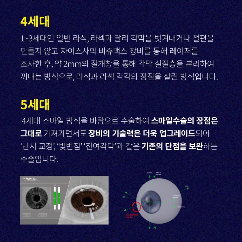 ความแตกต่างของประเภท Smile LASIK ที่ Gangnam Station Eye Clinic 사진 2