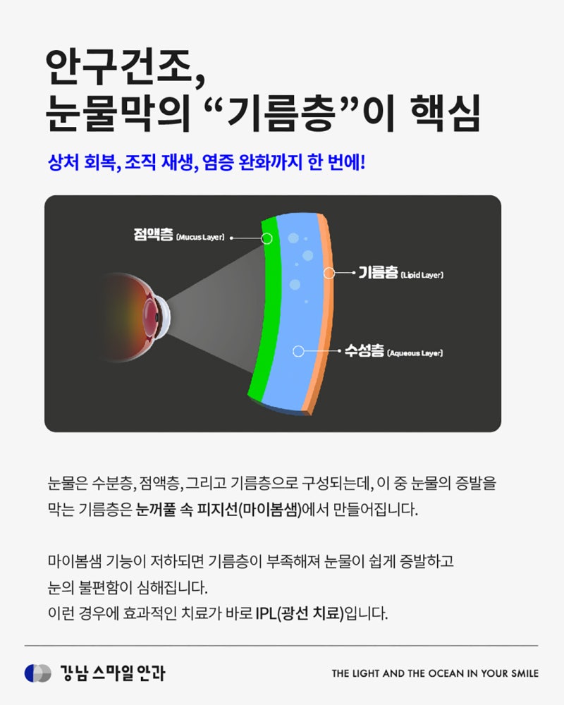 LASIK/LASEK术后干眼症原因及解决方案 | 江南站眼科 사진 3