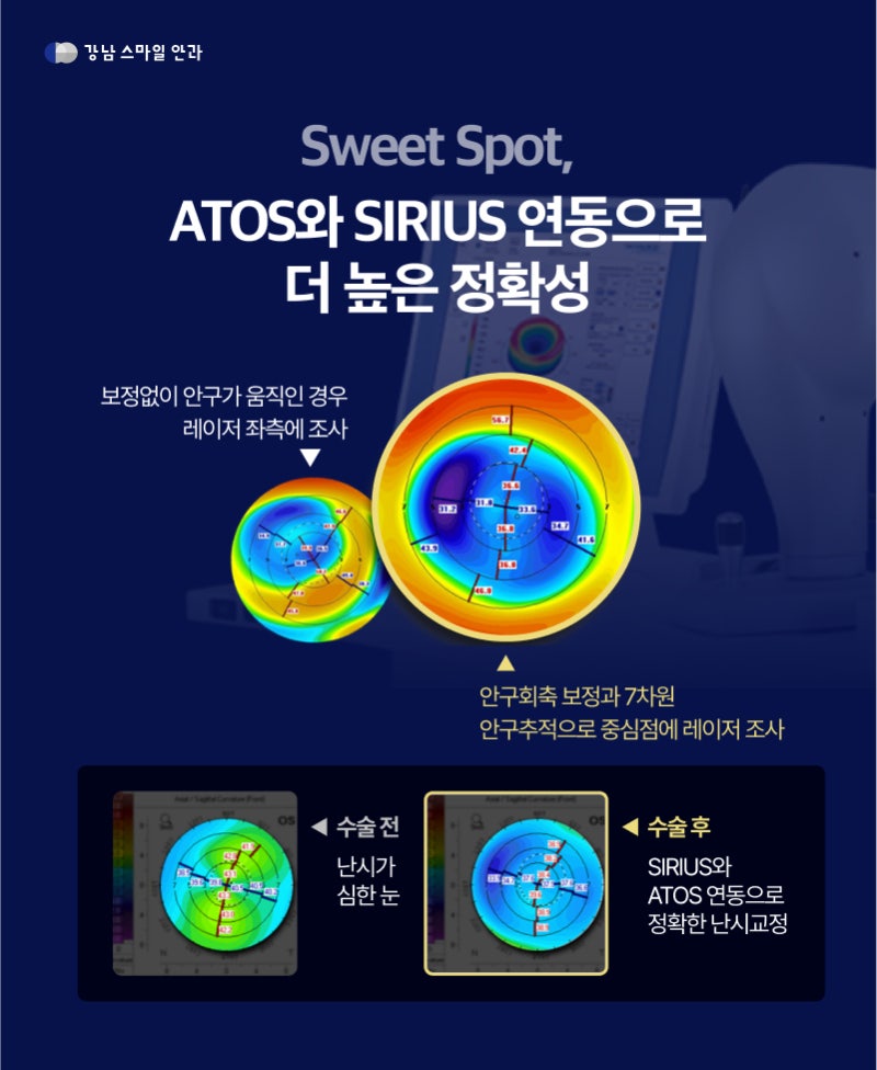 Phẫu thuật Smile Lasik cá nhân hóa, New Smile Lasik là gì? 사진 4
