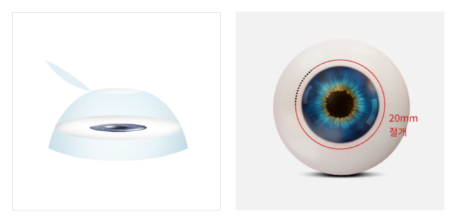 ความแตกต่างของ New SMILE PRO | แตกต่างจาก New SMILE LASIK เดิมอย่างไร?