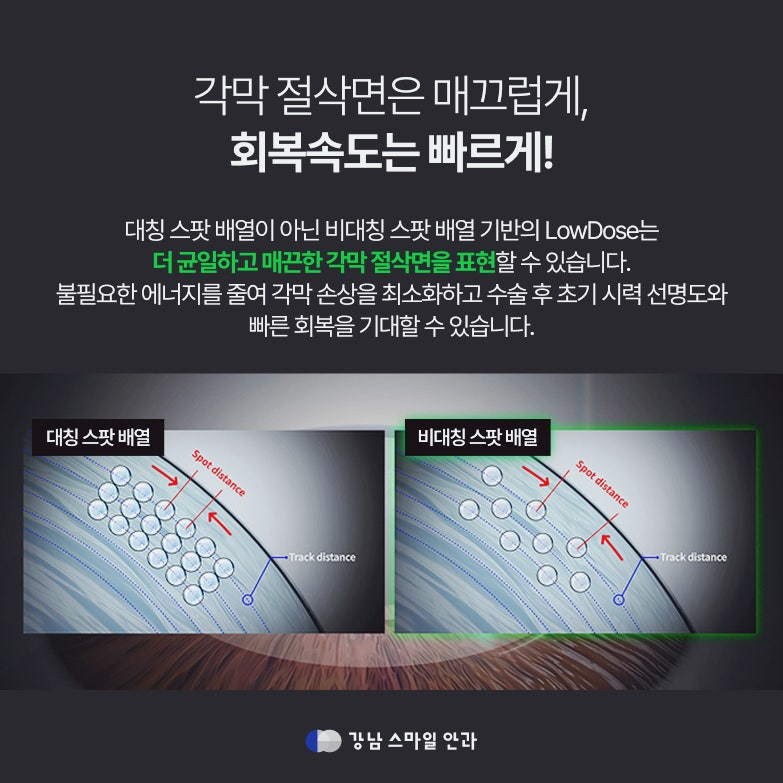 난시 교정까지 생각한다면? 서초동안과 스마트노바 라식 주목 사진 3
