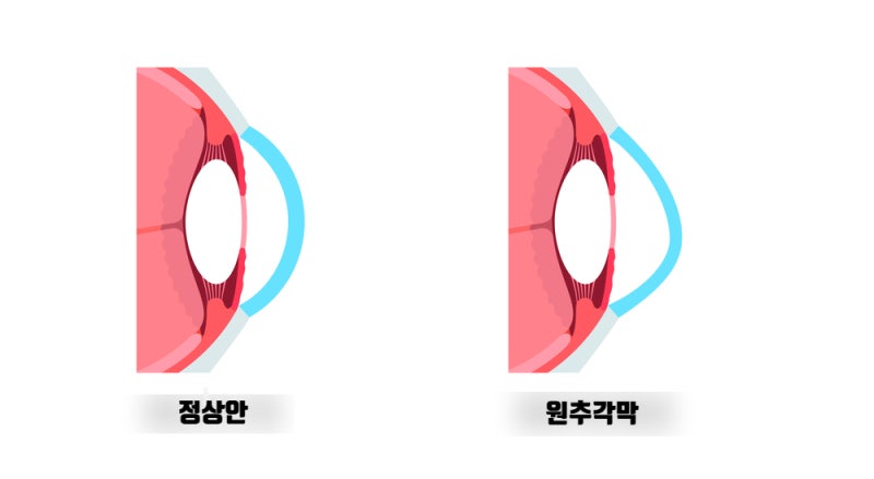 หาก LASIK/LASEK ทำได้ยาก? ICL ที่ช่วยรักษากระจกตา | สถานที่ทำศัลยกรรมฝังเลนส์ที่ดี