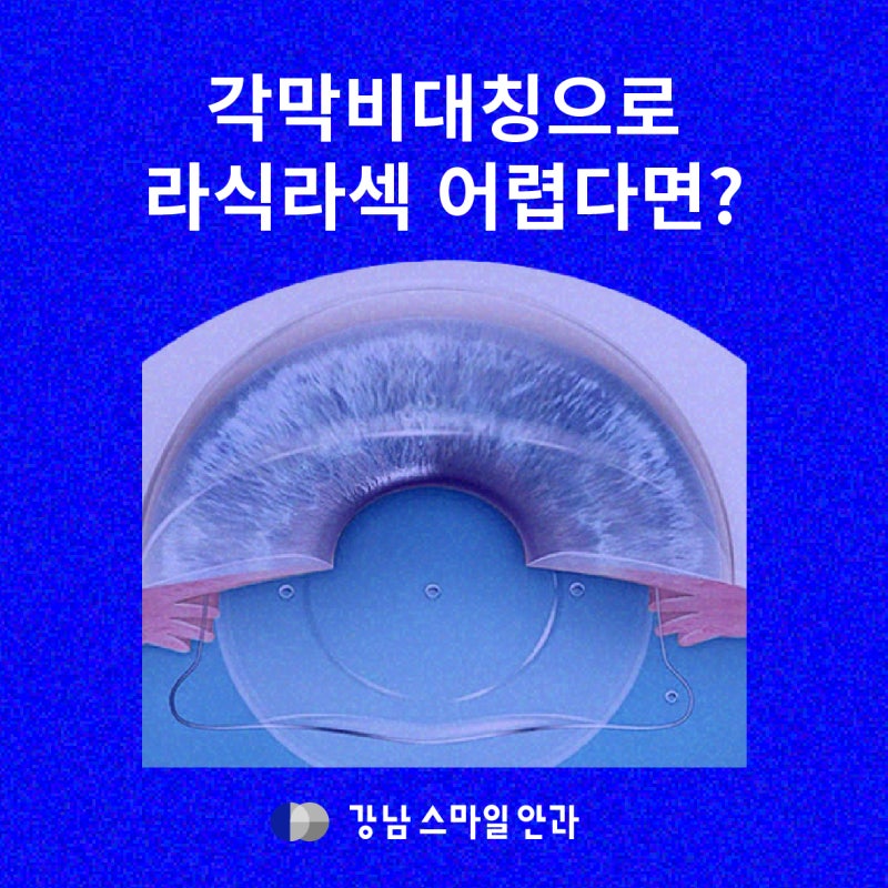 หาก LASIK/LASEK ทำได้ยาก? ICL ที่ช่วยรักษากระจกตา | สถานที่ทำศัลยกรรมฝังเลนส์ที่ดี