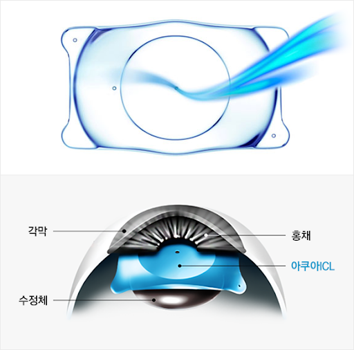 렌즈삽입술, 왜 최근 들어 더 많이 받을까? 사진 3