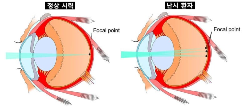 고도난시스마일라식, 정말 가능할까? 수술 전 확인해야할 기준 사진 2