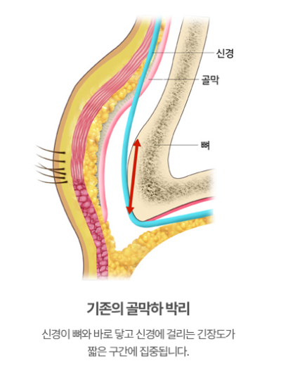 이마거상술·이마거상, 눈썹만 올리면 끝일까요? 수술층과 신경 보호의 핵심 | 테일러성형외과 사진 5