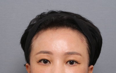 이마거상 부작용을 줄이는 듀얼플레인 수술법 — 내시경이마거상 임상 연구 결과 공개 | 테일러성형외과 사진 3