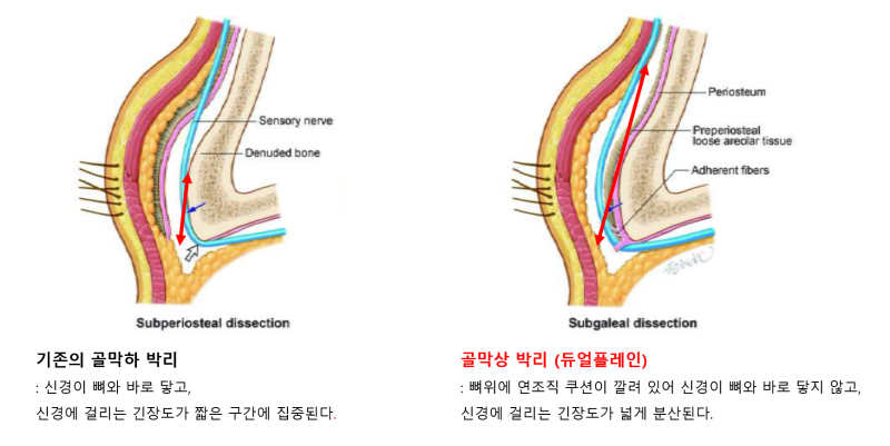 이마거상 부작용을 줄이는 듀얼플레인 수술법 — 내시경이마거상 임상 연구 결과 공개 | 테일러성형외과