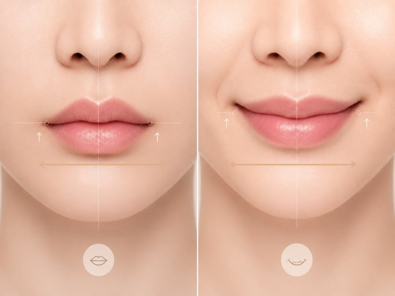 입술필러를 맞아도 왜 입이 짧아 보일까요? | 강남 입술필러 | 골든디아망성형외과 사진 6