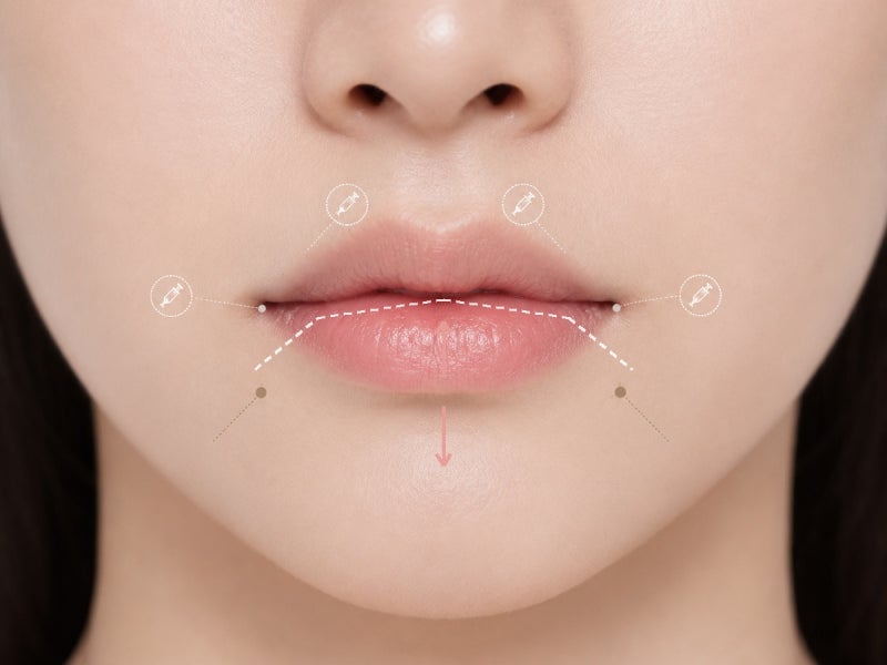 입술필러를 맞아도 왜 입이 짧아 보일까요? | 강남 입술필러 | 골든디아망성형외과 사진 5
