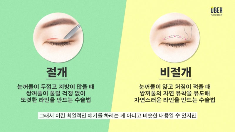 위버성형외과 서승조 원장님이 알려주는 절개 쌍꺼풀 vs 비절개 쌍꺼풀 비교 분석! 내 눈에 어울리는 쌍꺼풀은?