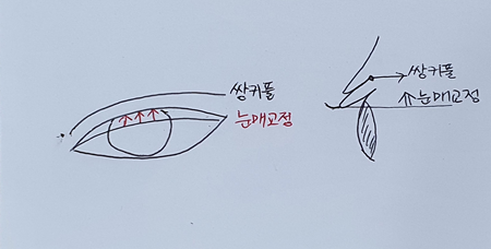 쌍커풀 수술을 할 때 눈매교정은 필수인가요?
