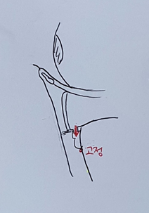 심정환 원장님이 알려주시는 눈밑지방재배치!