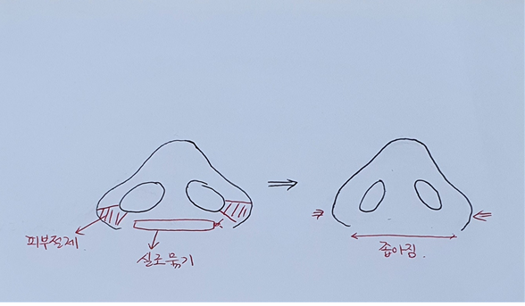 콧볼 축소만 해도 코가 높아보일까요?