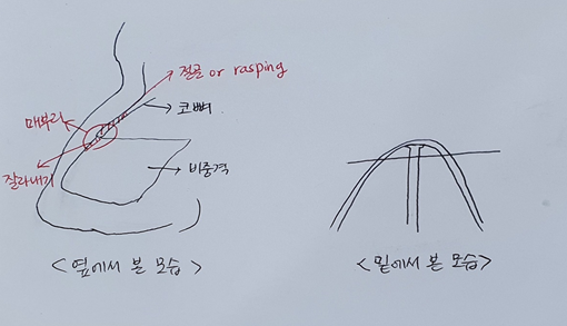 절골 해야하는 매부리와, 하지 않아도 되는 케이스는?
