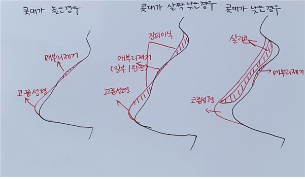 매부리만 깎아내거나, 매부리를 건드리지 않고 매끈한 코를 만들 수 있나요?